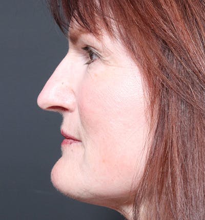 Non-Surgical Skin Resurfacing Before & After Gallery - Patient 14089589 - Image 6