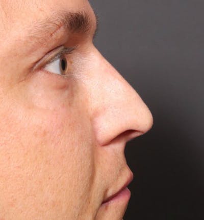 Non-Surgical Rhinoplasty Before & After Gallery - Patient 14089591 - Image 8