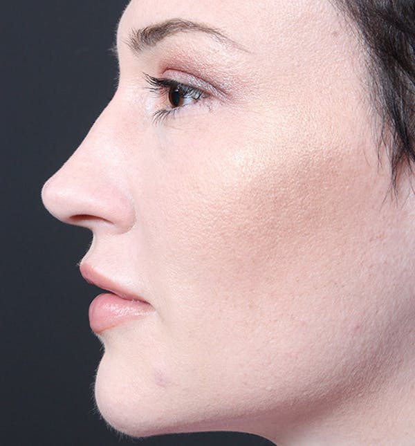 Injectables Before & After Gallery - Patient 14089592 - Image 6
