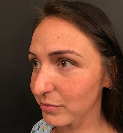 Non-Surgical Rhinoplasty Before & After Gallery - Patient 14089597 - Image 1