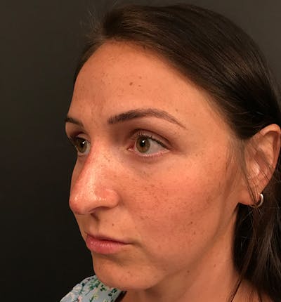 Non-Surgical Rhinoplasty Before & After Gallery - Patient 14089597 - Image 2