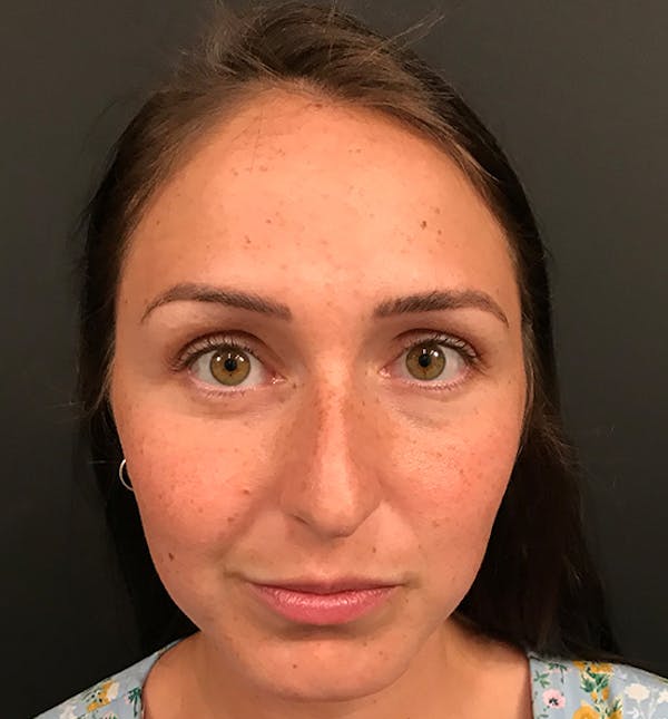 Non-Surgical Rhinoplasty Before & After Gallery - Patient 14089597 - Image 3
