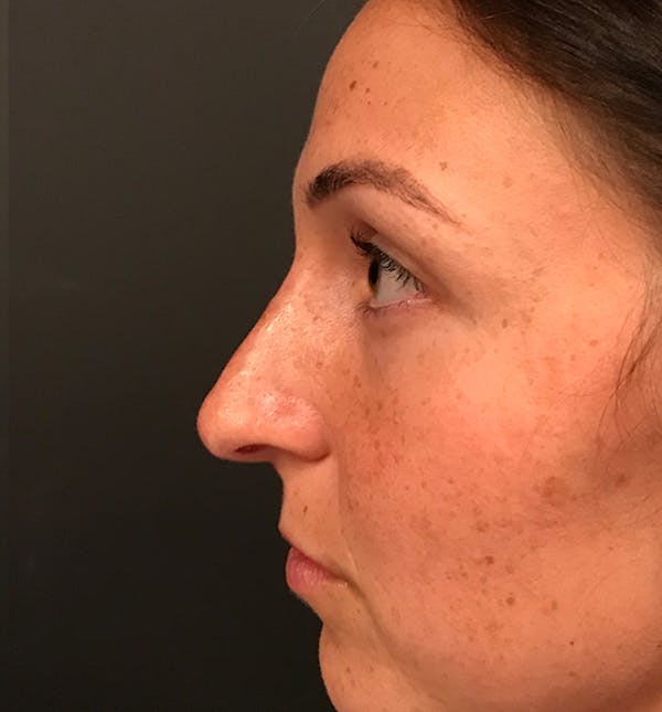 Non-Surgical Rhinoplasty Before & After Gallery - Patient 14089597 - Image 6