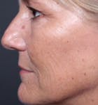 Injectables Before & After Gallery - Patient 14089602 - Image 1