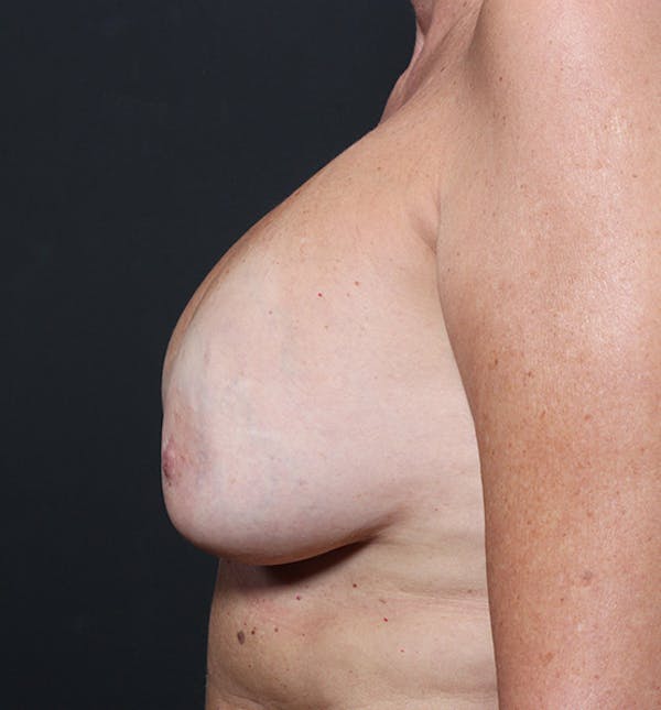 Breast Implant Revision Before & After Gallery - Patient 14089603 - Image 5