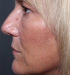 Injectables Before & After Gallery - Patient 14089602 - Image 2