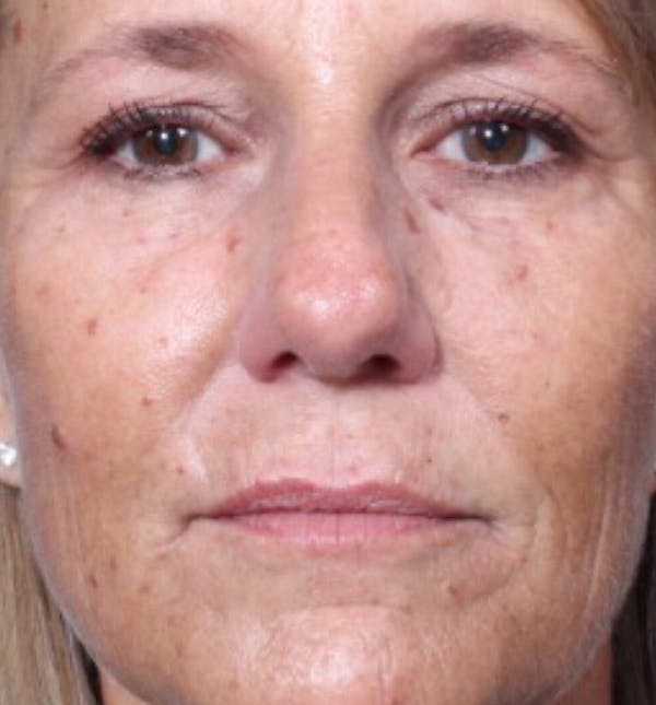 Injectables Before & After Gallery - Patient 14089602 - Image 3