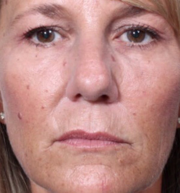 Injectables Before & After Gallery - Patient 14089602 - Image 4