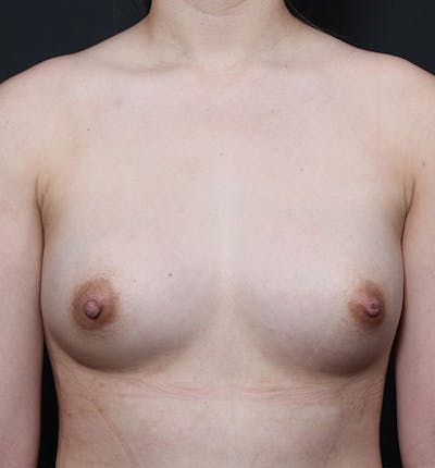 Breast Aug Fat Grafting Before & After Gallery - Patient 14089609 - Image 4