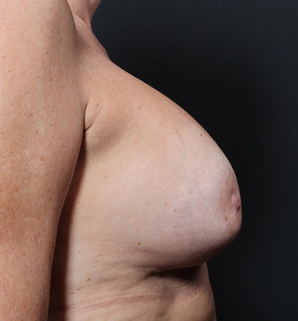 Breast Implant Revision Before & After Gallery - Patient 14089603 - Image 9