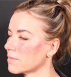 Injectables Before & After Gallery - Patient 14089613 - Image 2