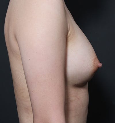 Breast Aug Fat Grafting Before & After Gallery - Patient 14089609 - Image 8