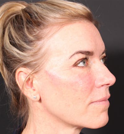 Injectables Before & After Gallery - Patient 14089613 - Image 6