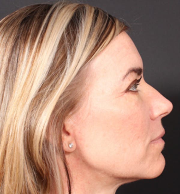 Injectables Before & After Gallery - Patient 14089613 - Image 7
