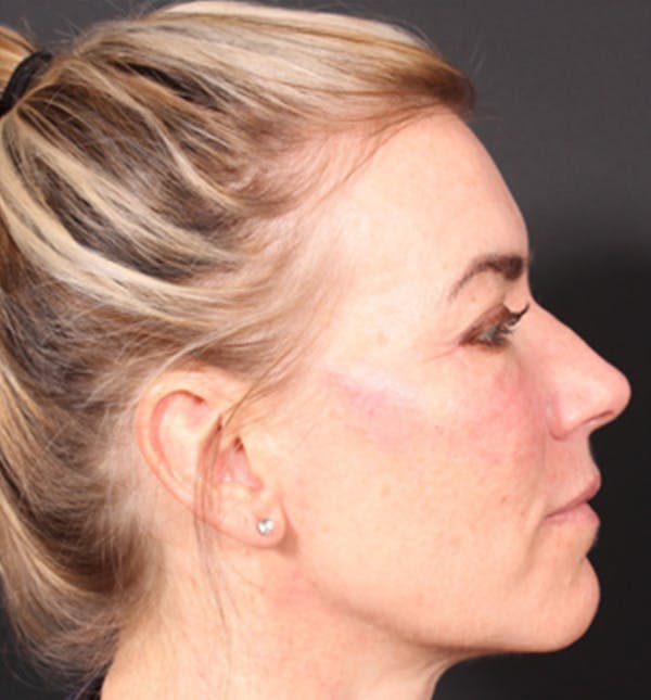 Injectables Before & After Gallery - Patient 14089613 - Image 8
