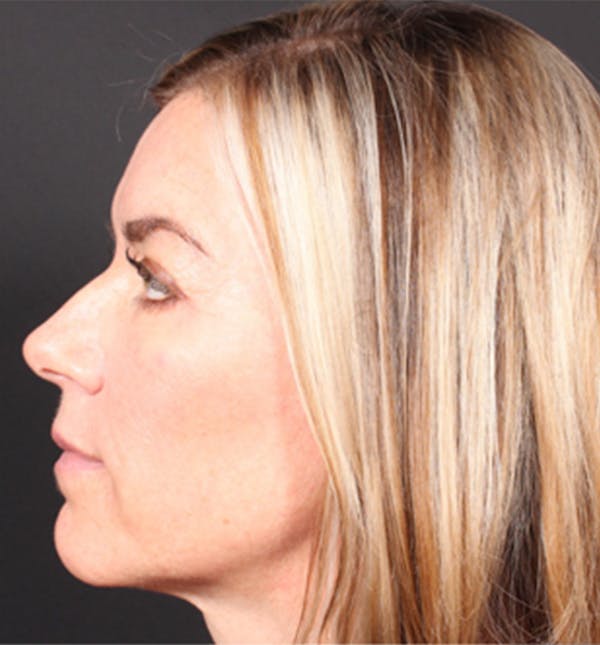 Injectables Before & After Gallery - Patient 14089613 - Image 9