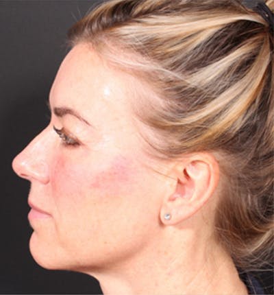 Injectables Before & After Gallery - Patient 14089613 - Image 10