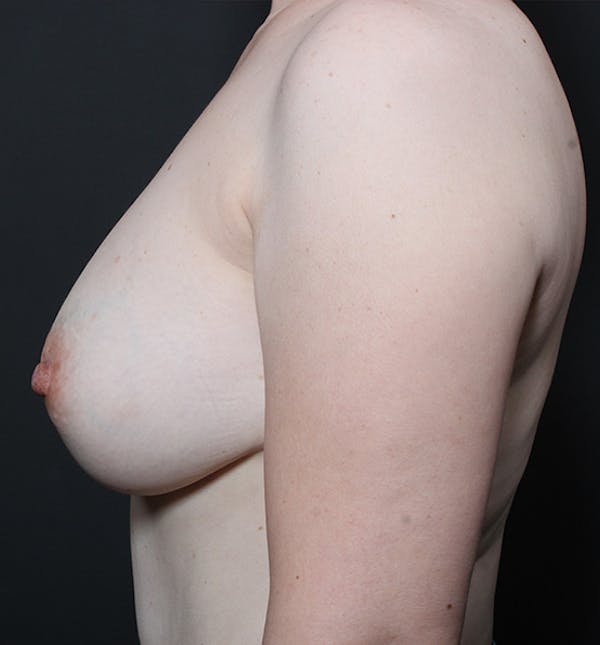 Breast Lift Mastopexy Before & After Gallery - Patient 14089617 - Image 5