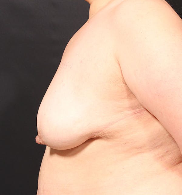 Breast Aug Fat Grafting Before & After Gallery - Patient 14089623 - Image 5