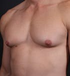 Male Chest Reduction Before & After Gallery - Patient 14089628 - Image 1