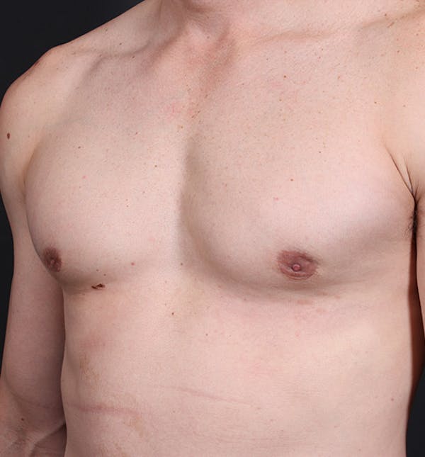 Male Chest Reduction Before & After Gallery - Patient 14089628 - Image 2