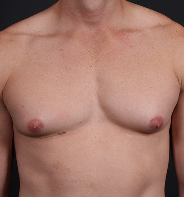 Male Chest Reduction Before & After Gallery - Patient 14089628 - Image 3