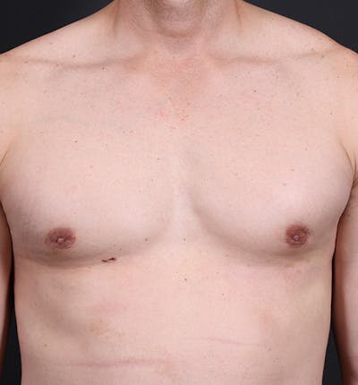 Male Chest Reduction Before & After Gallery - Patient 14089628 - Image 4