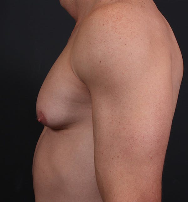 Male Chest Reduction Before & After Gallery - Patient 14089628 - Image 5
