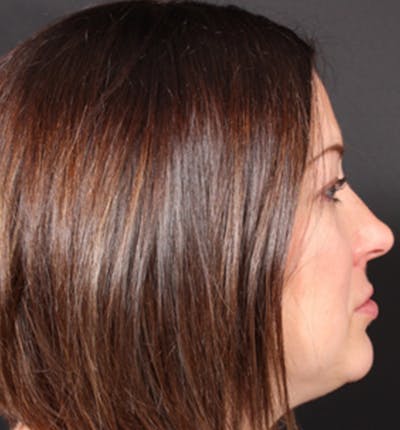 Injectables Before & After Gallery - Patient 14089629 - Image 6