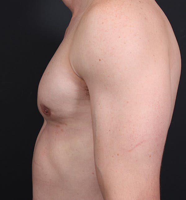 Male Chest Reduction Before & After Gallery - Patient 14089628 - Image 6