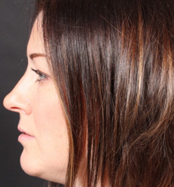 Injectables Before & After Gallery - Patient 14089629 - Image 7