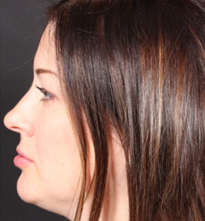 Injectables Before & After Gallery - Patient 14089629 - Image 8