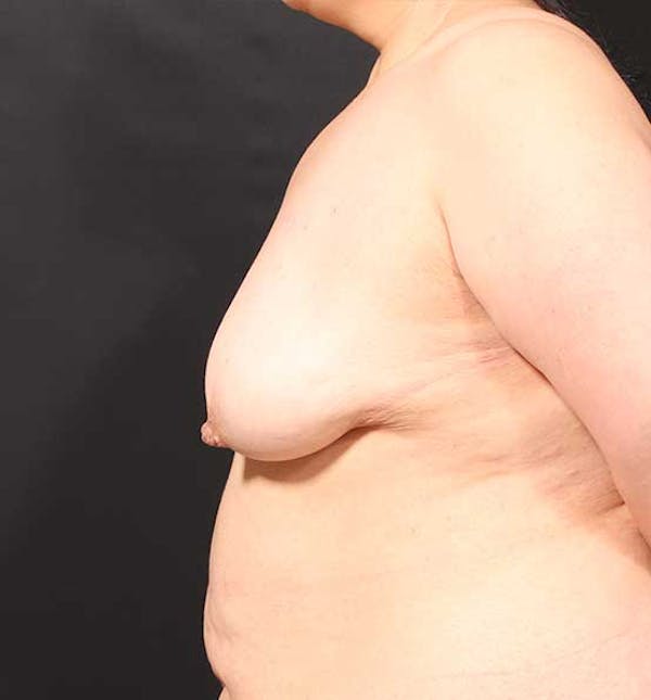 Breast Aug Fat Grafting Before & After Gallery - Patient 14089631 - Image 5