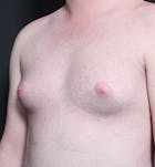 Male Chest Reduction Before & After Gallery - Patient 14089635 - Image 1