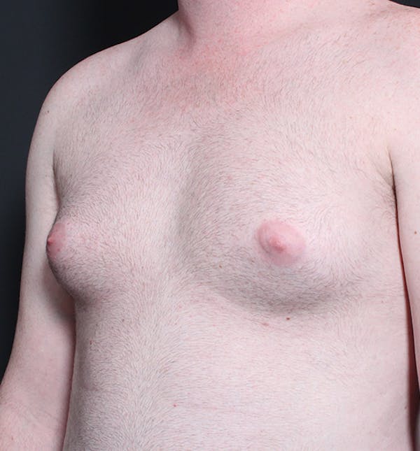 Male Chest Reduction Before & After Gallery - Patient 14089635 - Image 1