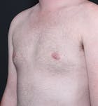 Male Chest Reduction Before & After Gallery - Patient 14089635 - Image 2