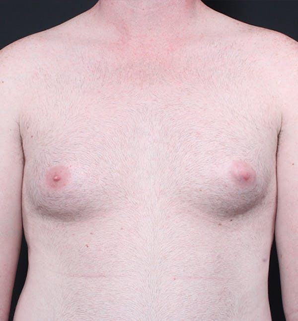 Male Chest Reduction Before & After Gallery - Patient 14089635 - Image 3