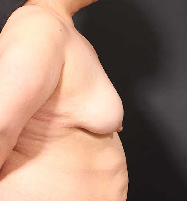 Breast Aug Fat Grafting Before & After Gallery - Patient 14089631 - Image 9