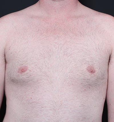 Male Chest Reduction Before & After Gallery - Patient 14089635 - Image 4