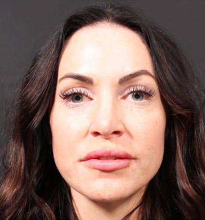 Injectables Before & After Gallery - Patient 14089642 - Image 4