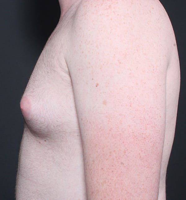 Male Chest Reduction Before & After Gallery - Patient 14089635 - Image 5