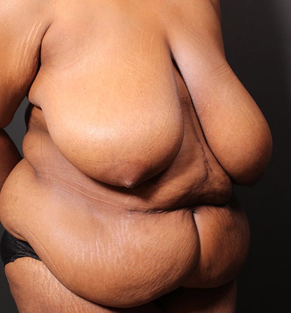 Breast Reduction Before & After Gallery - Patient 14089637 - Image 7