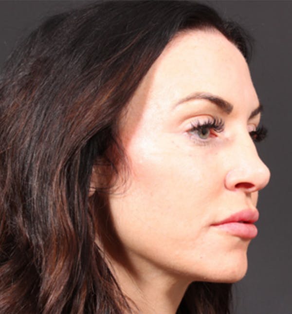 Injectables Before & After Gallery - Patient 14089642 - Image 6