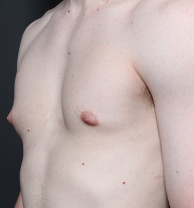 Male Chest Reduction Before & After Gallery - Patient 14089646 - Image 1