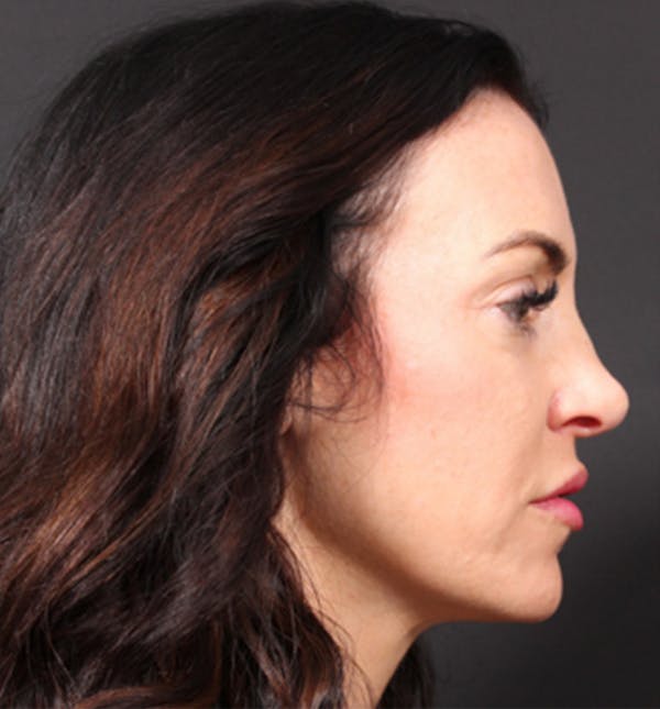Injectables Before & After Gallery - Patient 14089642 - Image 7