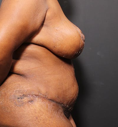 Breast Reduction Before & After Gallery - Patient 14089637 - Image 10