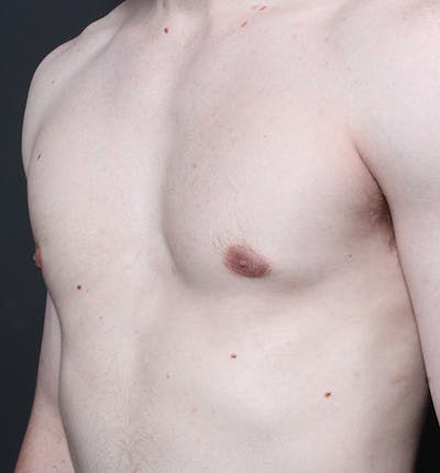 Male Chest Reduction Before & After Gallery - Patient 14089646 - Image 2