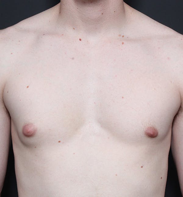 Male Chest Reduction Before & After Gallery - Patient 14089646 - Image 3