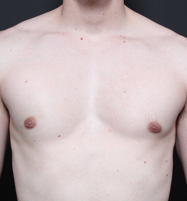 Male Chest Reduction Before & After Gallery - Patient 14089646 - Image 4