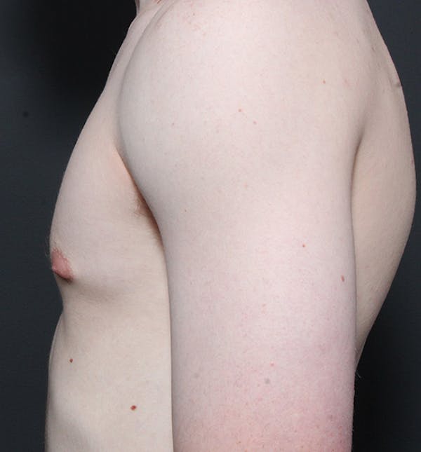 Male Chest Reduction Before & After Gallery - Patient 14089646 - Image 5